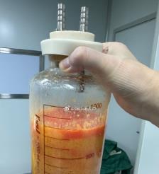 神木水动力吸脂手术要做多久？